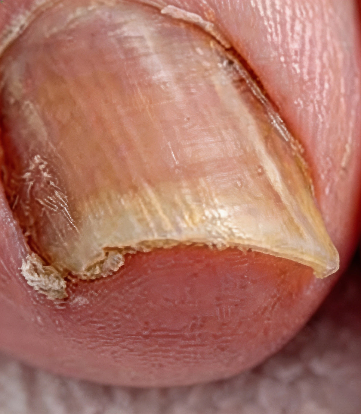 Tough Edges & Big Toenails