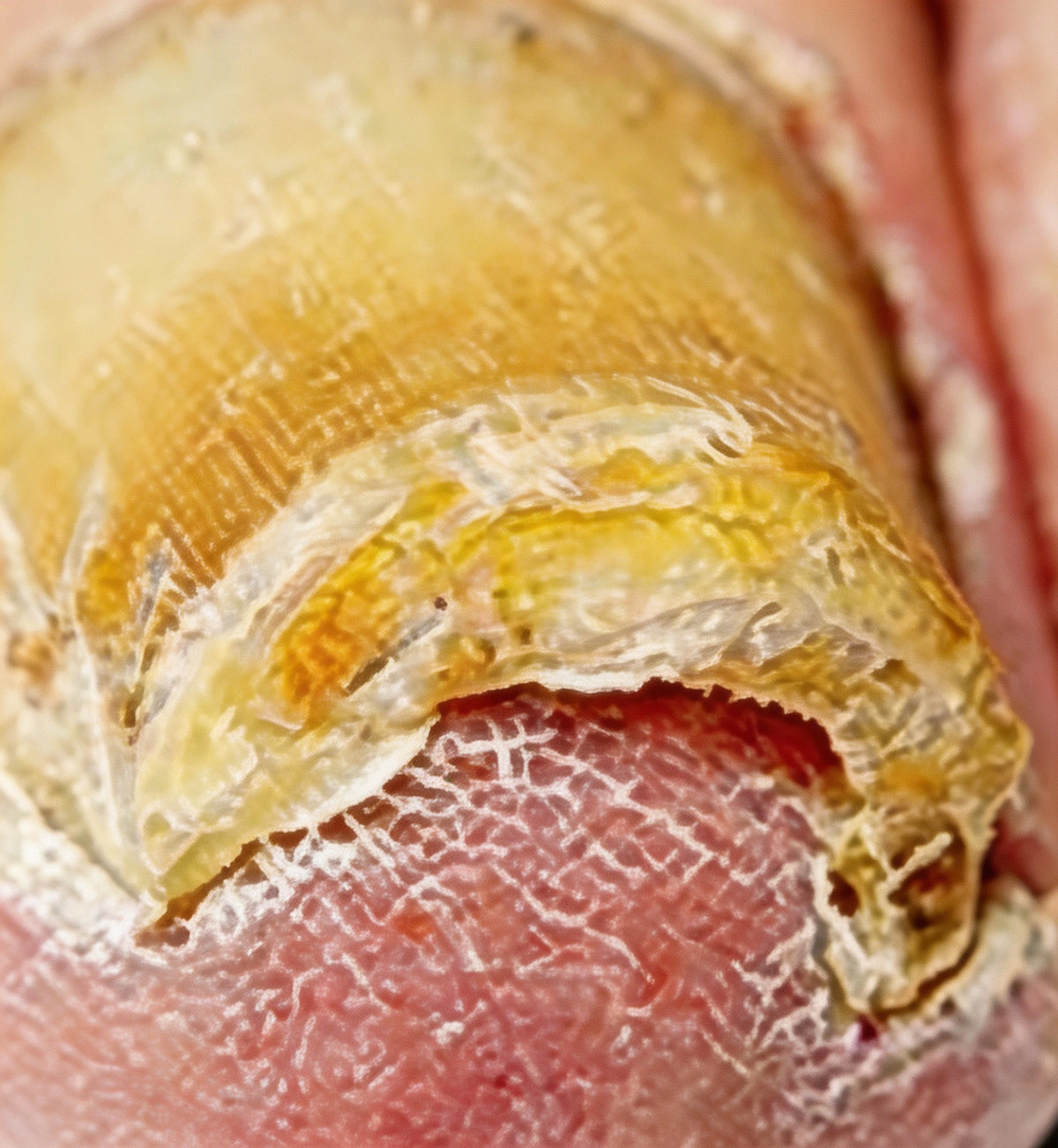 Aging & Thickened Nails